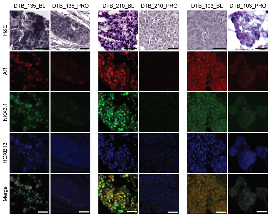 Matched patient biopsies offer insight into resistance mechanisms in prostate cancer