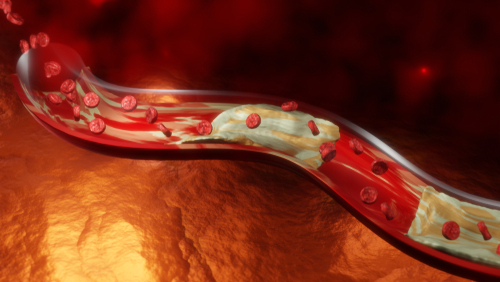 Peripheral arterial disease