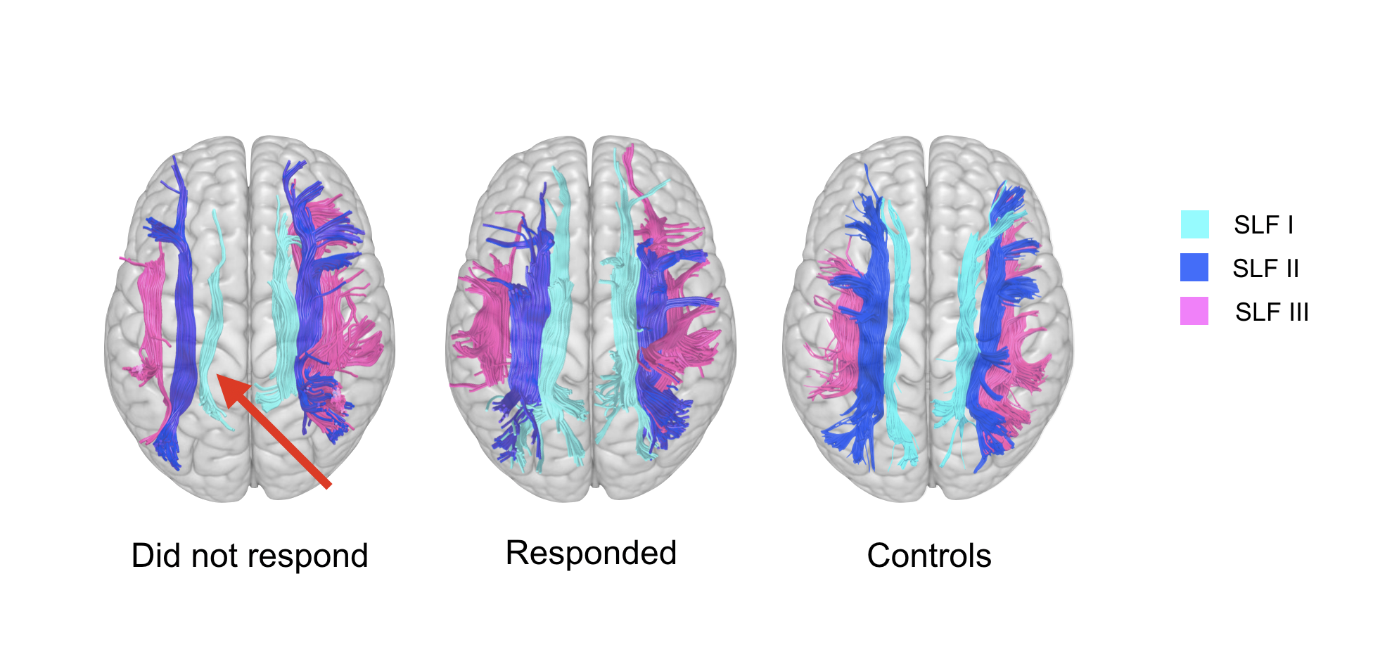 POOR RESPONSE TO METHYLPHENIDATE IS ASSOCIATED WITH A SMALLER DORSAL ATTENTIVE NETWORK IN ADULT ATTENTION-DEFICIT/HYPERACTIVITY DISORDER (ADHD).