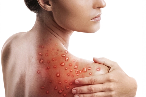Monkeypox – how can community pharmacy teams help?