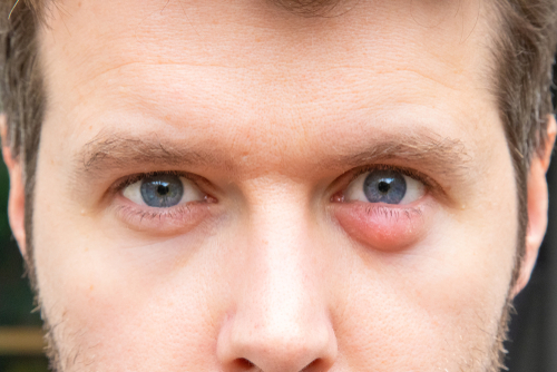 Identifying common eyelid disorders