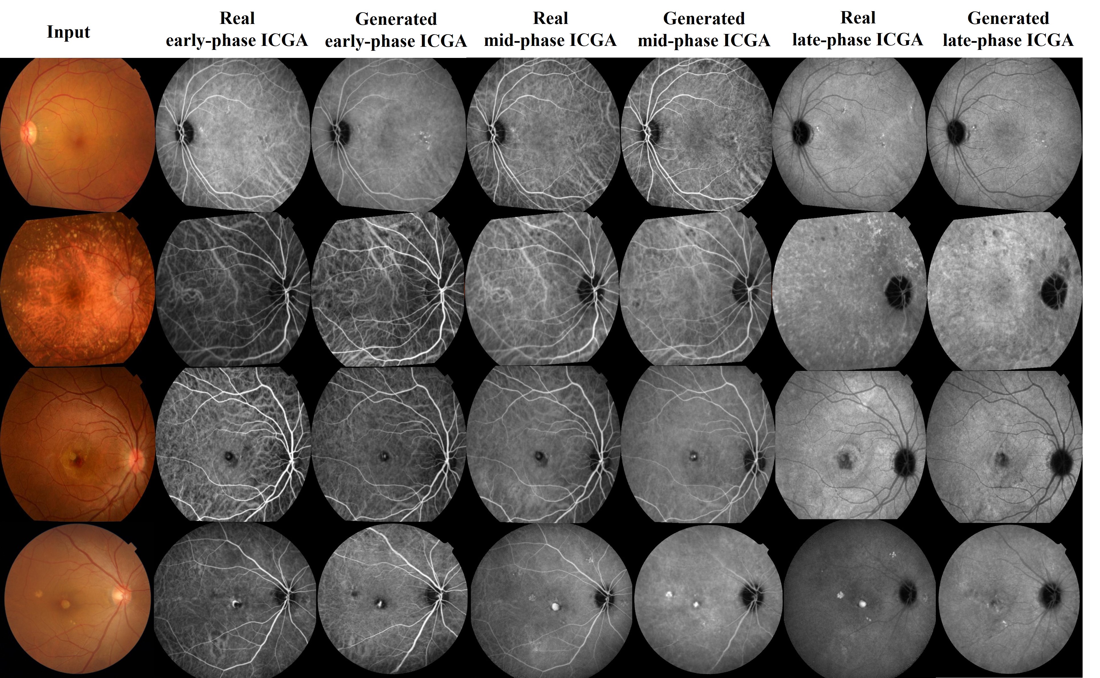 Generative AI: A Game-Changer in Age-Related Macular Degeneration Screening by Achieving ‘Noninvasive’ Indocyanine Green Angiography 