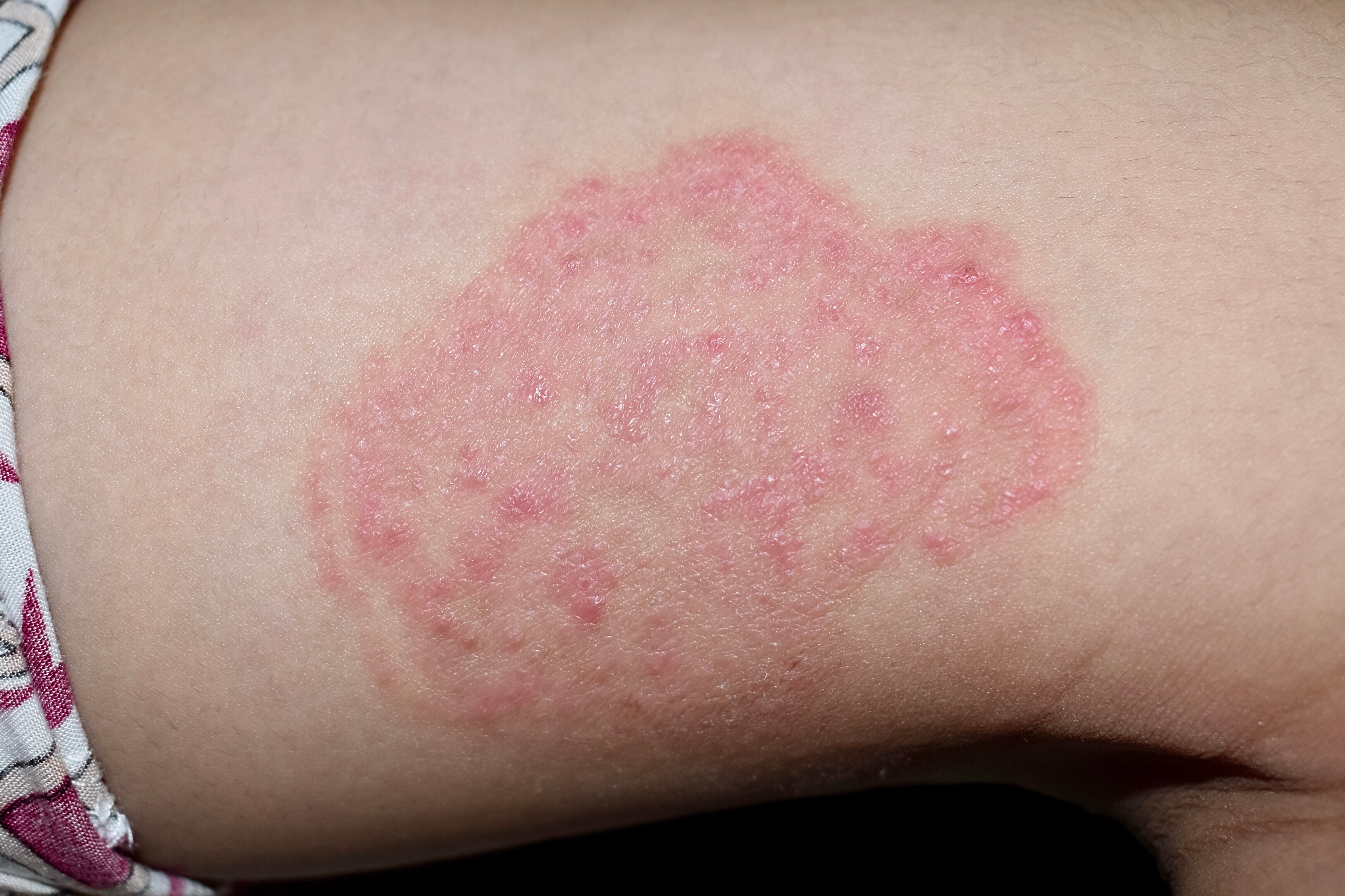 Introduction to cutaneous infections