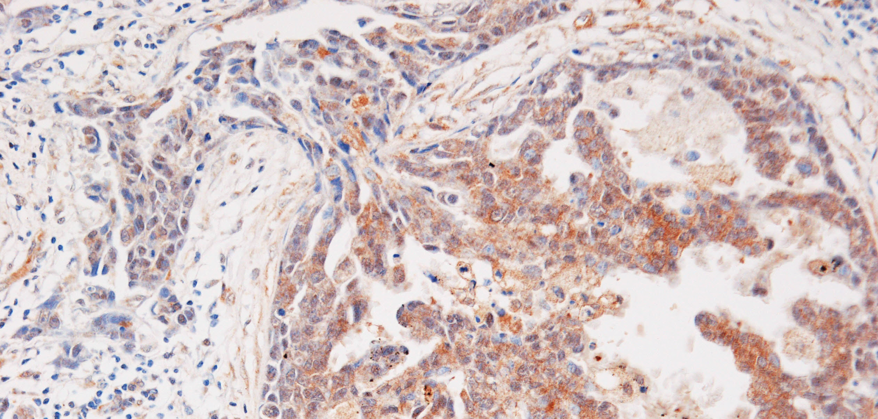 Exploring the link between cholesterol and cancer pathophysiology: from nuclear receptors to chemoresistance