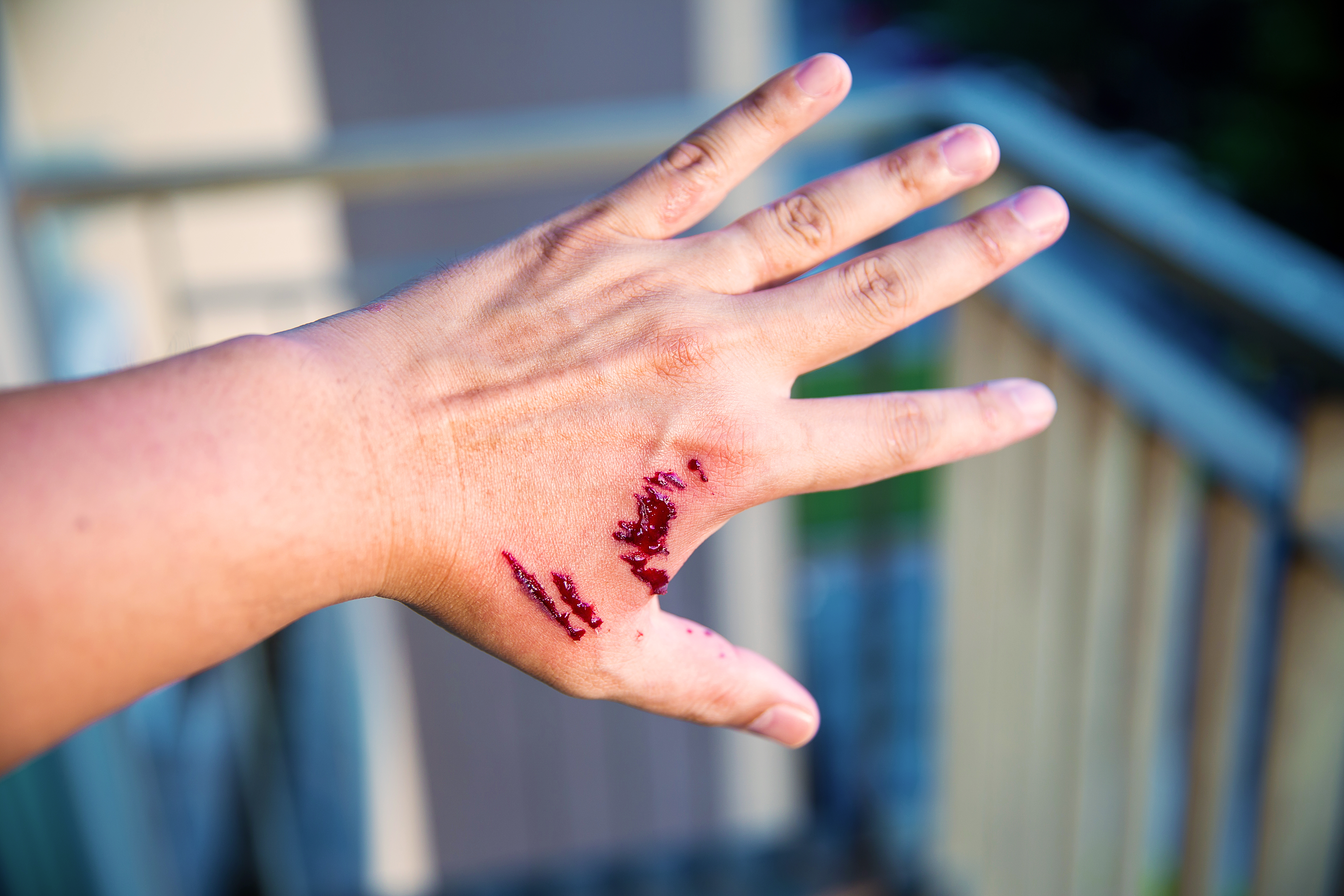 Nice guideline summary: Human and animal bites – antimicrobial prescribing 