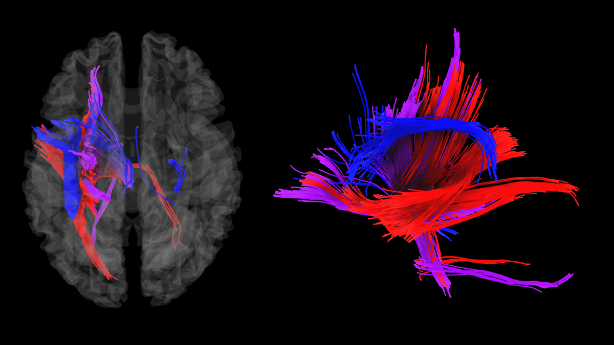 Neural Harmony: Unveiling the Shared Left-Hemisphere Pathways of Speech and Song