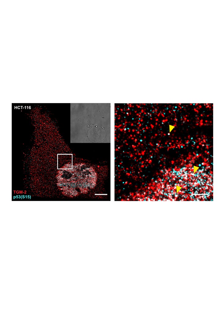 Transglutaminase 2 activation: an alternative way to suppress p53 function in colorectal cancer