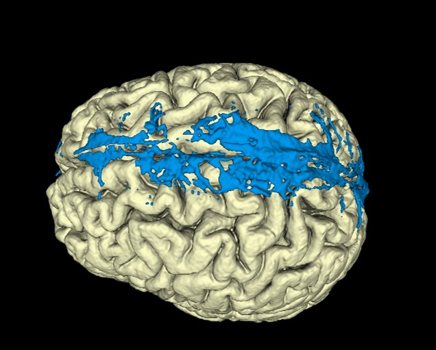 Parasagittal dura is a potential neuroimmune interface