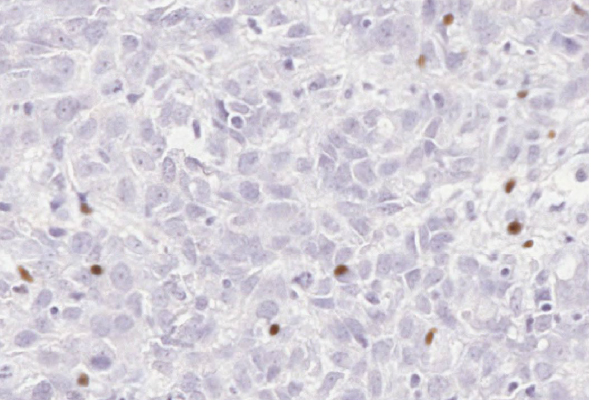 Unlocking the potential for immune checkpoint inhibitors in Metaplastic Breast Cancers.