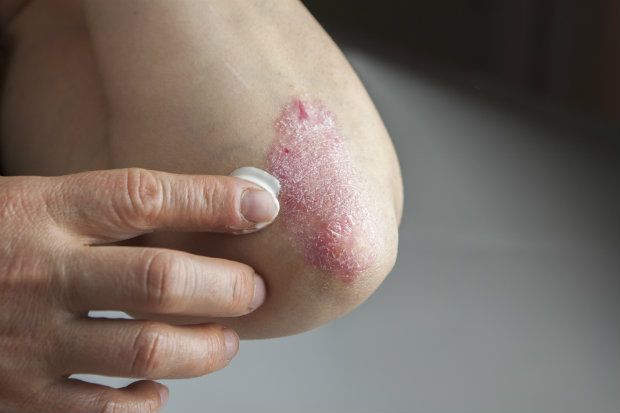 Psoriasis: treatments