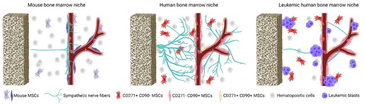 Profound sympathetic neuropathy in the bone marrow of patients with acute myeloid leukemia