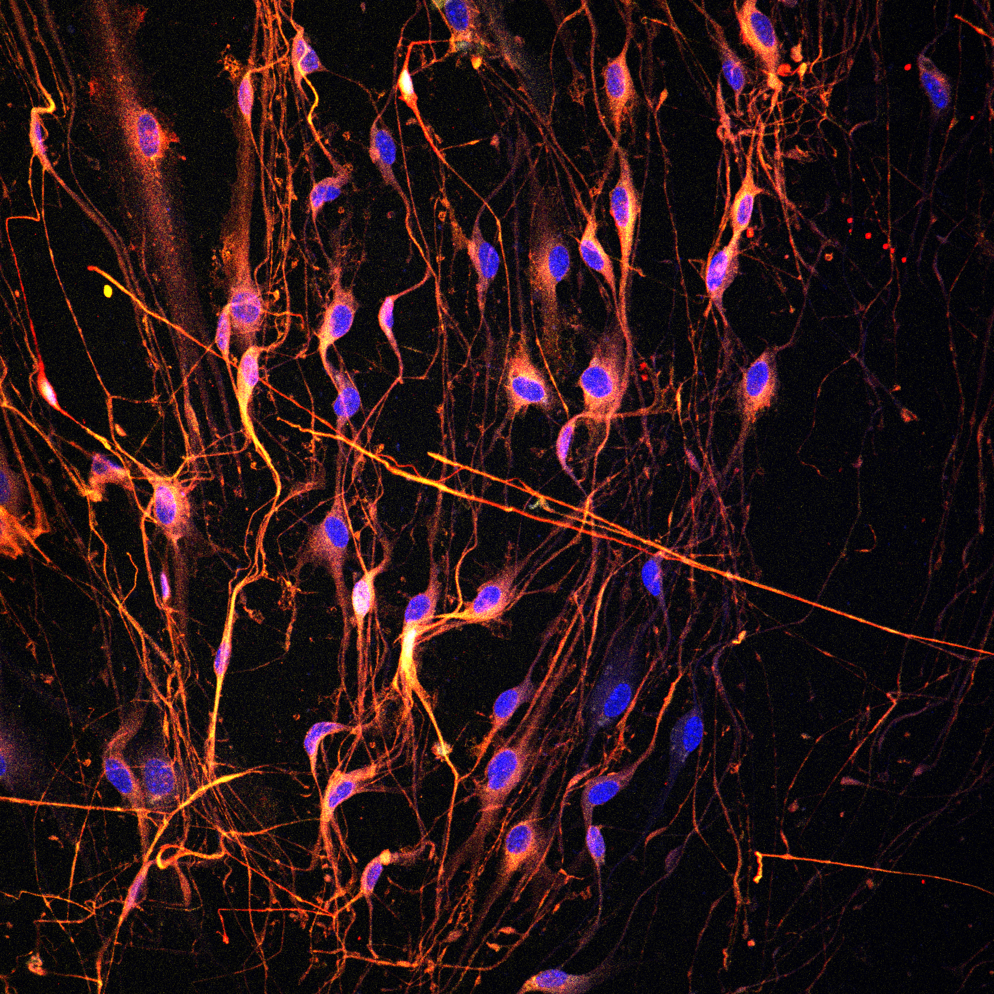 Chasing Ghosts – The Quest to Capture Neurons in Pancreatic Cancer