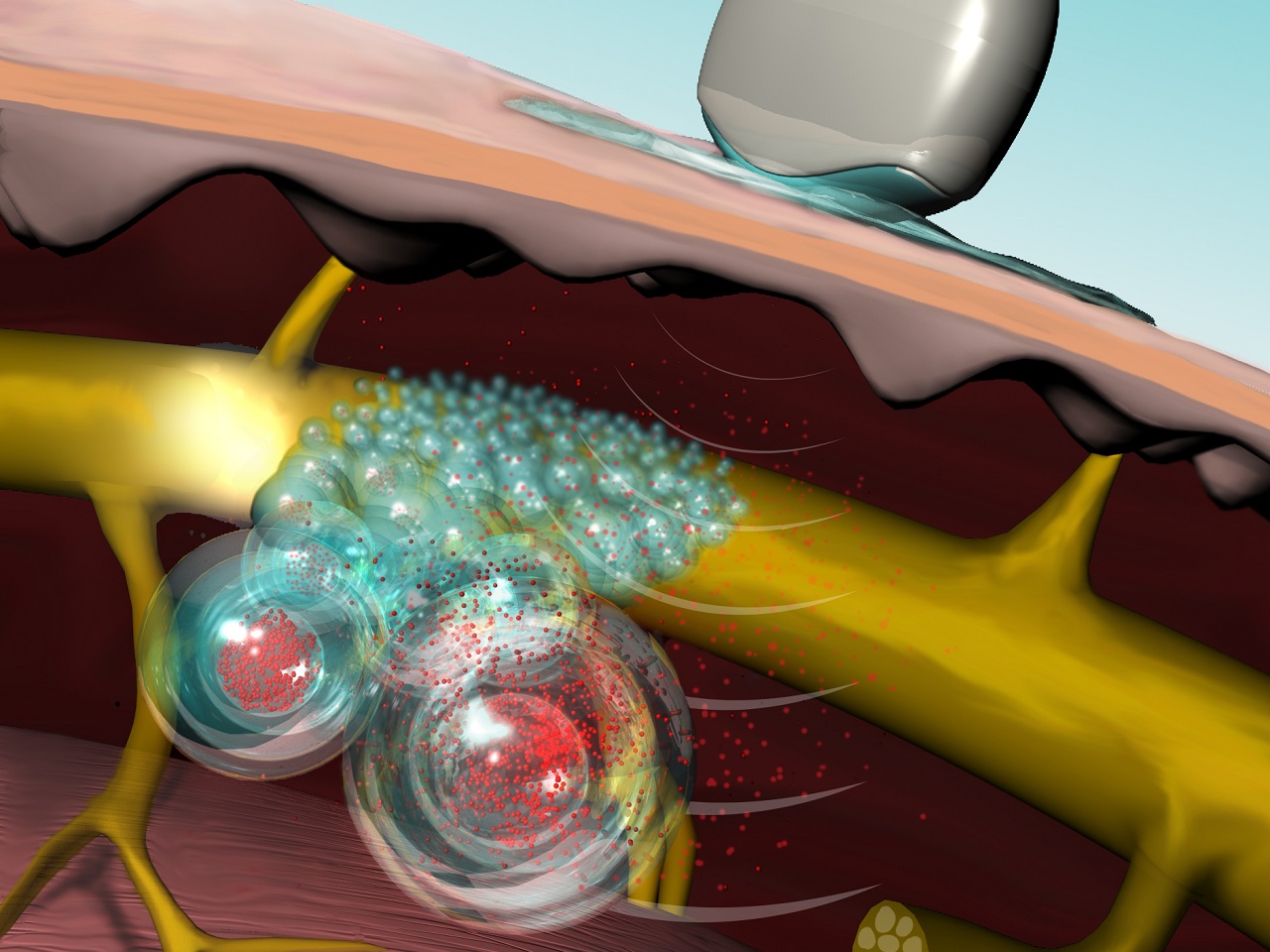 Ultrasound-triggerable local anaesthesia