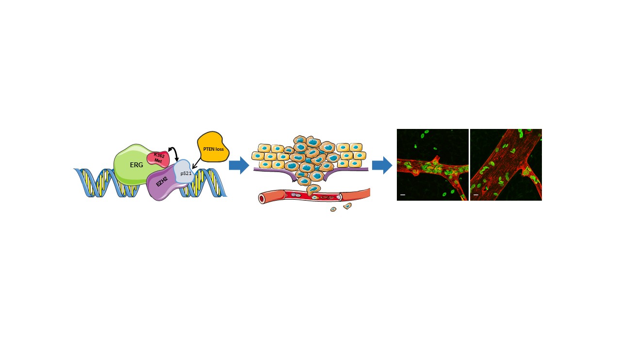 A molecular switch activates ERG and promotes prostate cancer progression 