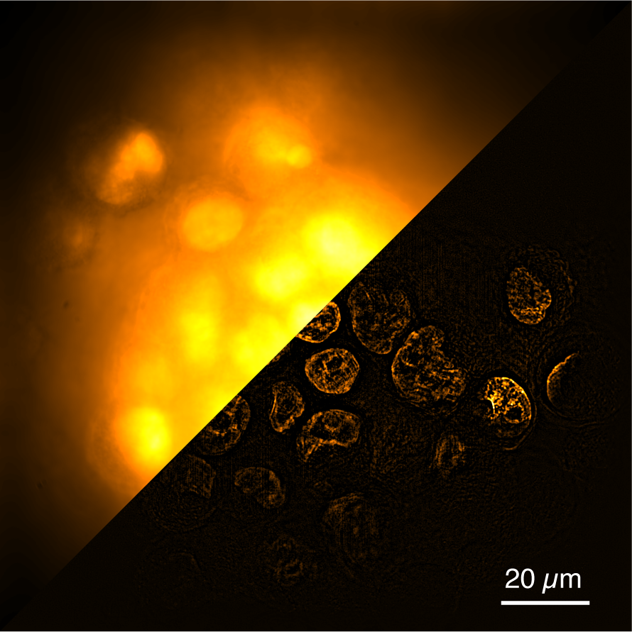 The journey to SPA for volumetric structured illumination microscopy 