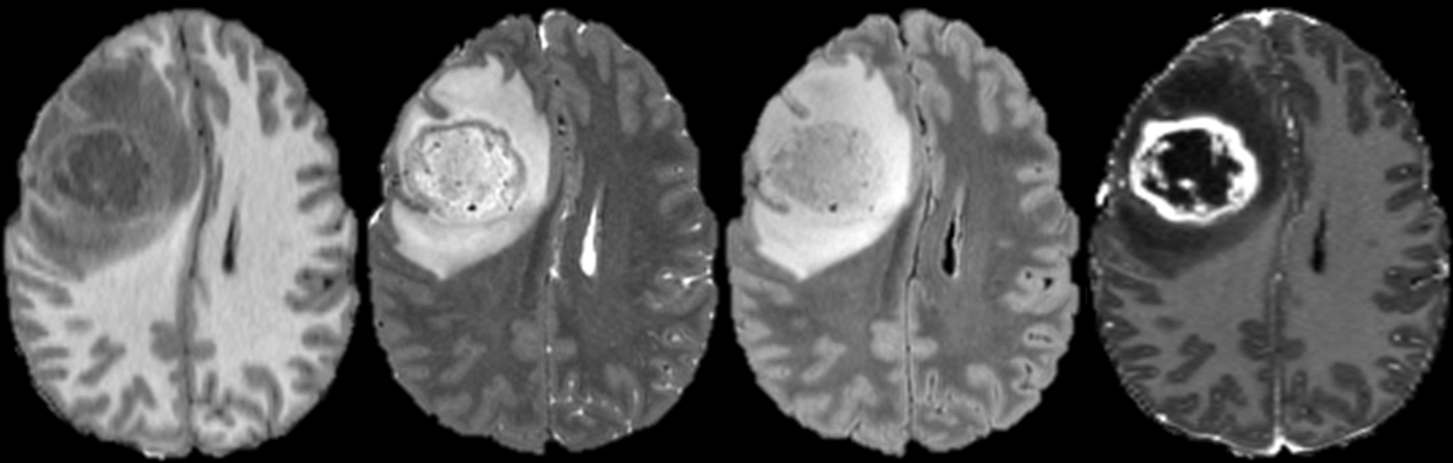 A fully automated artificial intelligence method for non-invasive, imaging-based identification of genetic alterations in glioblastomas