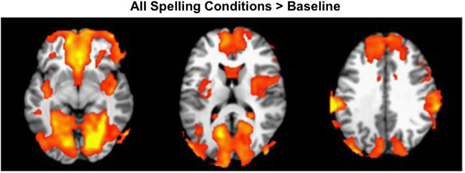 Editorial Summary—The method of educational assessment affects children’s neural processing and performance: behavioural and fMRI Evidence
