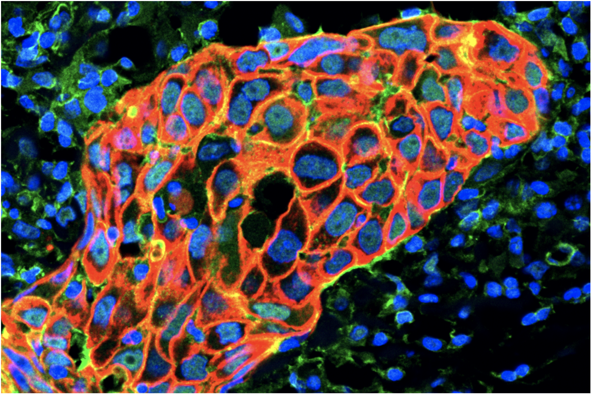 RAGE drives cell plasticity in metastatic TNBC