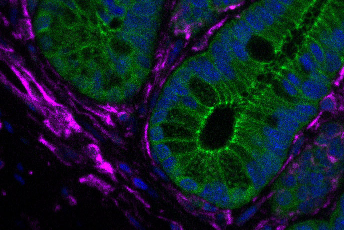 Fibroblasts drive gut tumorigenesis