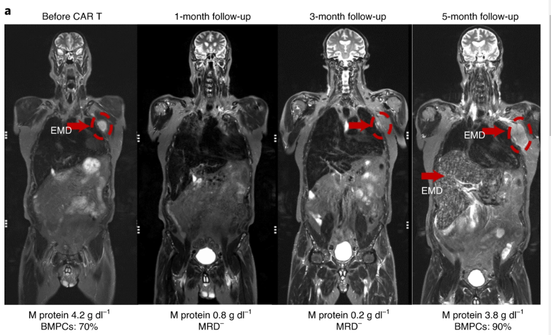 Good KarMMA for CAR T cells in myeloma