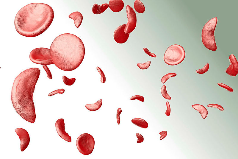 SDG 3: Sickle Cell Disease and its Impact on the Black community