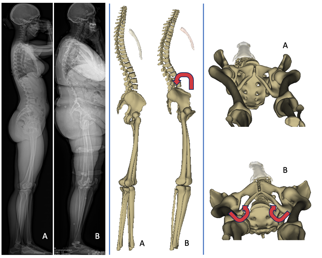 Femoral neck version in the spinopelvic and lower limb 3D alignment: a full-body EOS® study in 400 healthy subjects