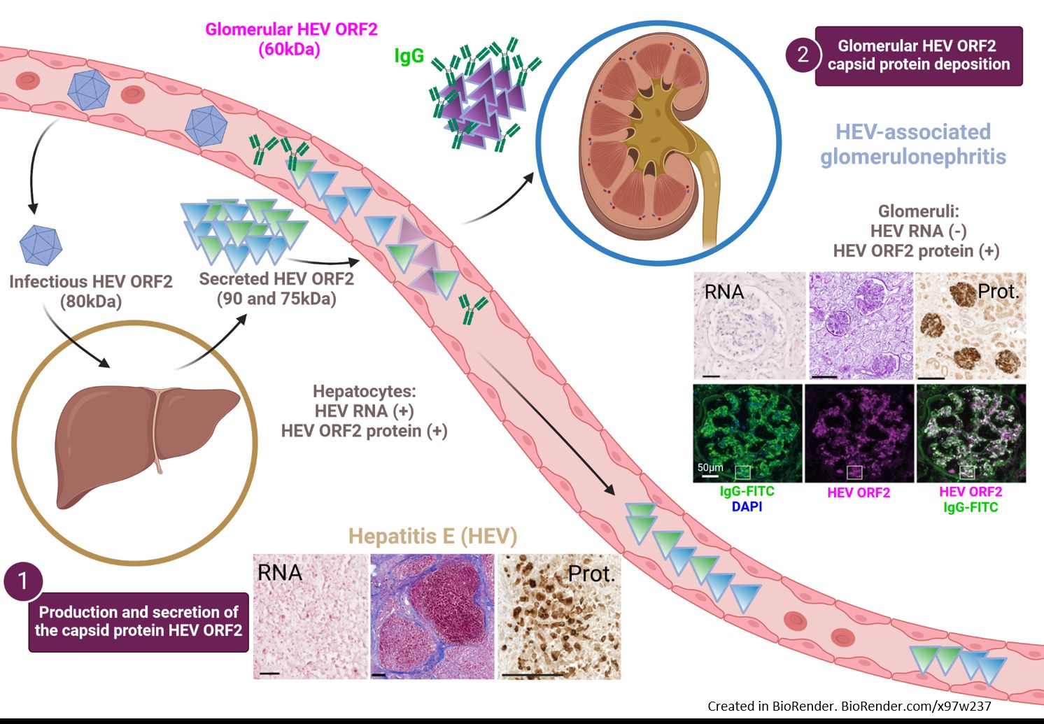 “When death delights in helping the living” – by unraveling a link between hepatitis E and kidney disease