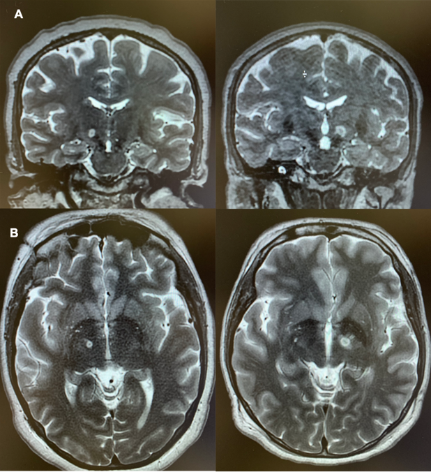 Advancing Parkinson's Treatment through MRgFUS Subthalamotomy