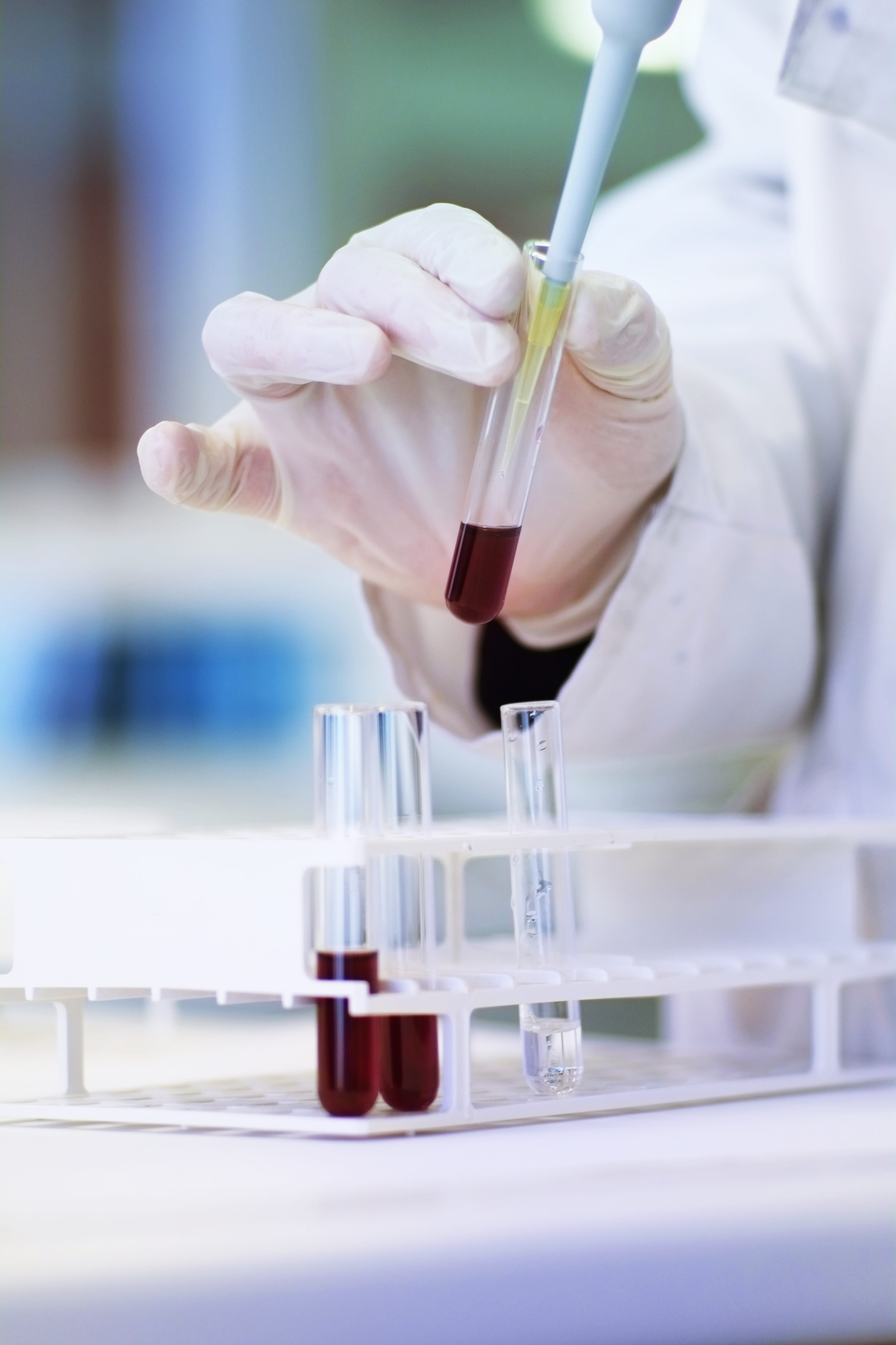 Monitoring immunotherapy responses in patients with advanced-stage lung cancer 