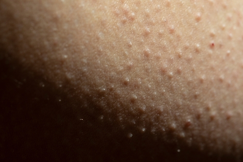 Does this patient have keratosis pilaris?