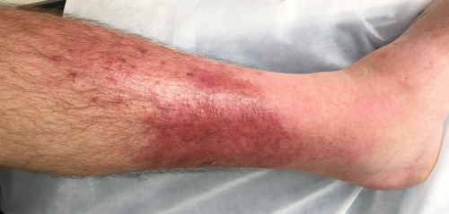 Cellulitis: symptoms, causes and management