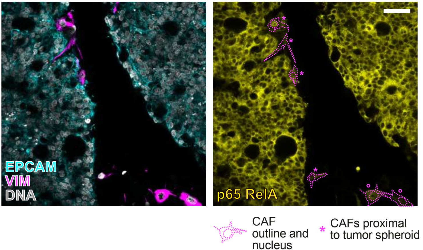 Silencing the Saboteurs - The IL1R1+ CAFs Fueling Colorectal Cancer Growth