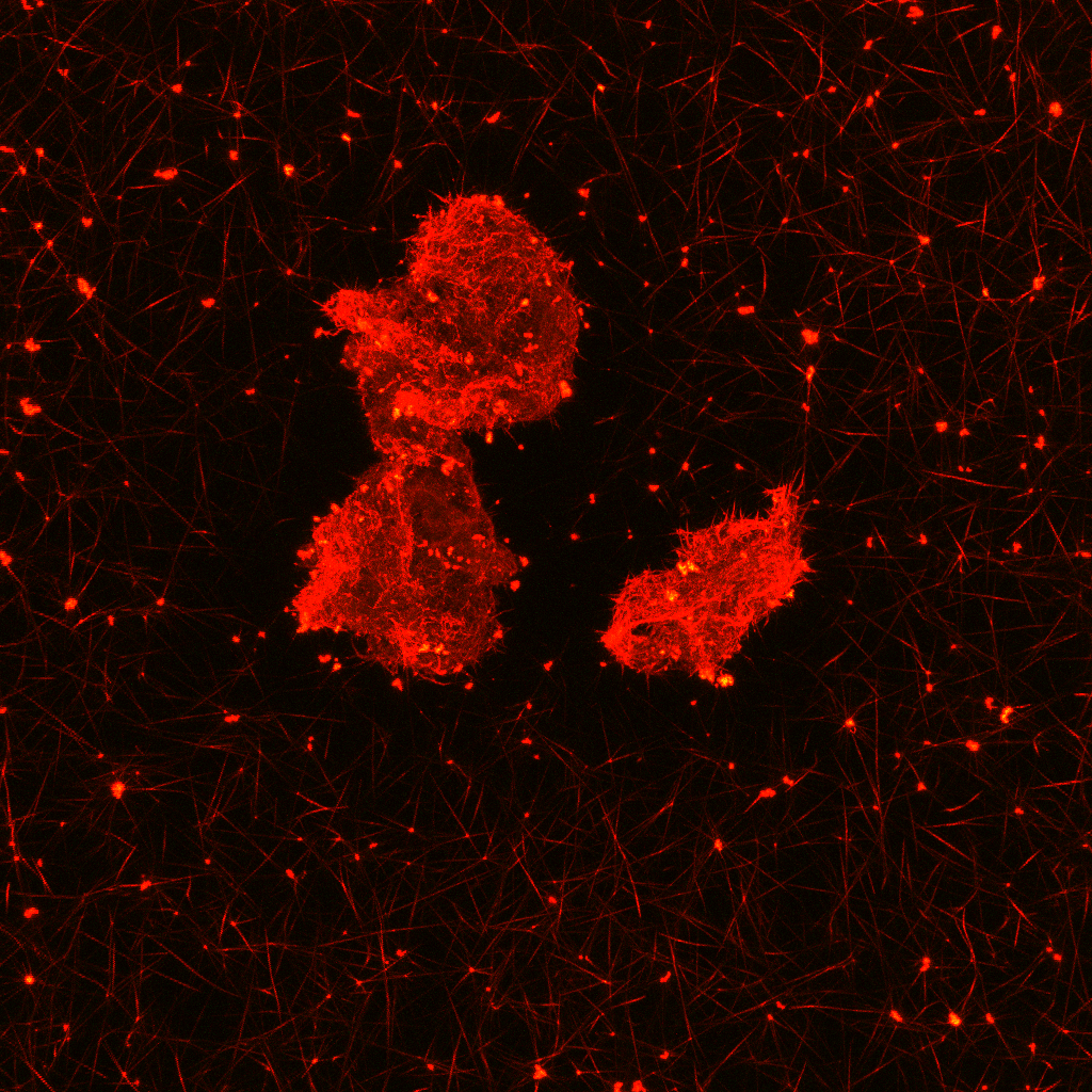 Microscopic fibrin aggregates in patients with thromboembolism