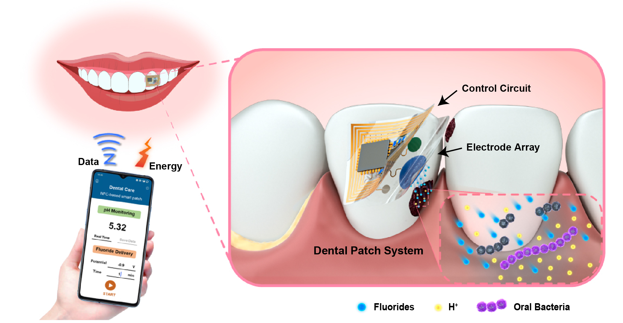 Flexible electronics armed to the teeth: Wearable theranostic dental patch for intraoral sensing and drug delivery