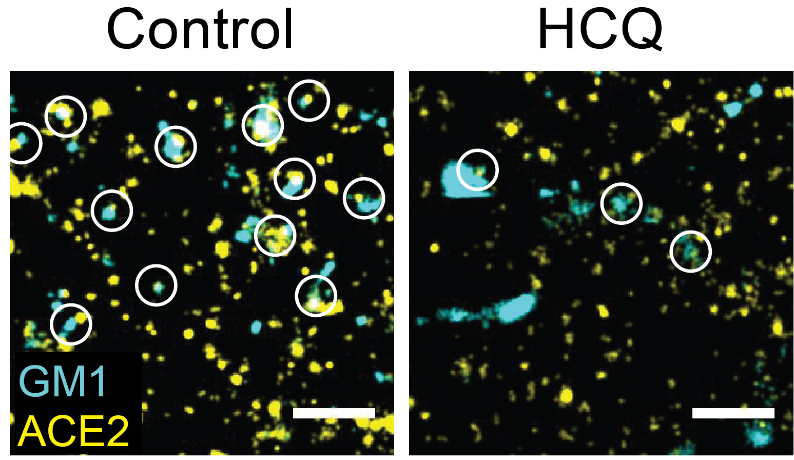 Hydroxychloroquine: blocking a portal to viral entry. 