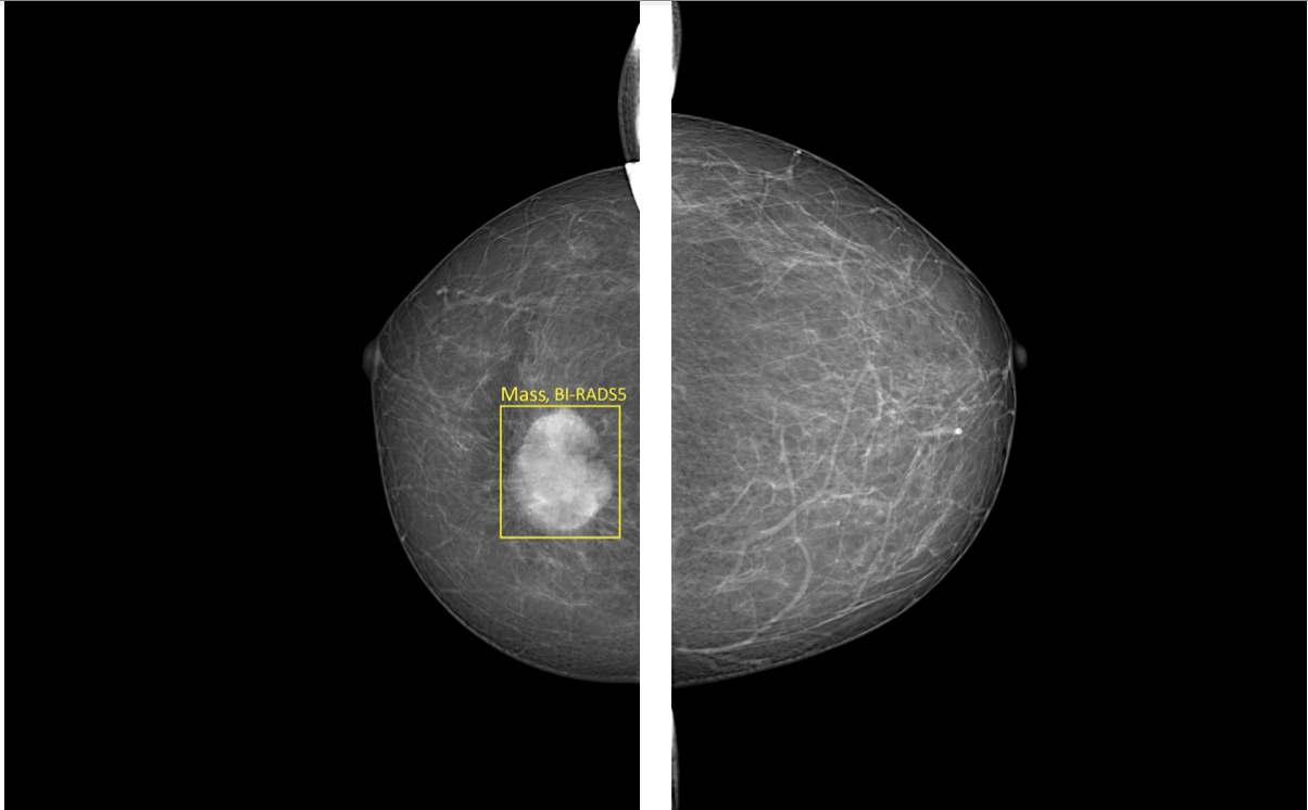 VinDr-Mammo: The largest public dataset of full-field digital mammography to evaluate and compare algorithmic support systems for breast cancer screening
