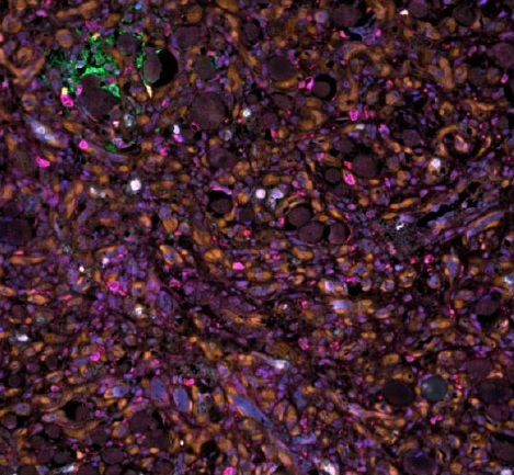 Understanding the immune responses in angiosarcomas and their clinical implications