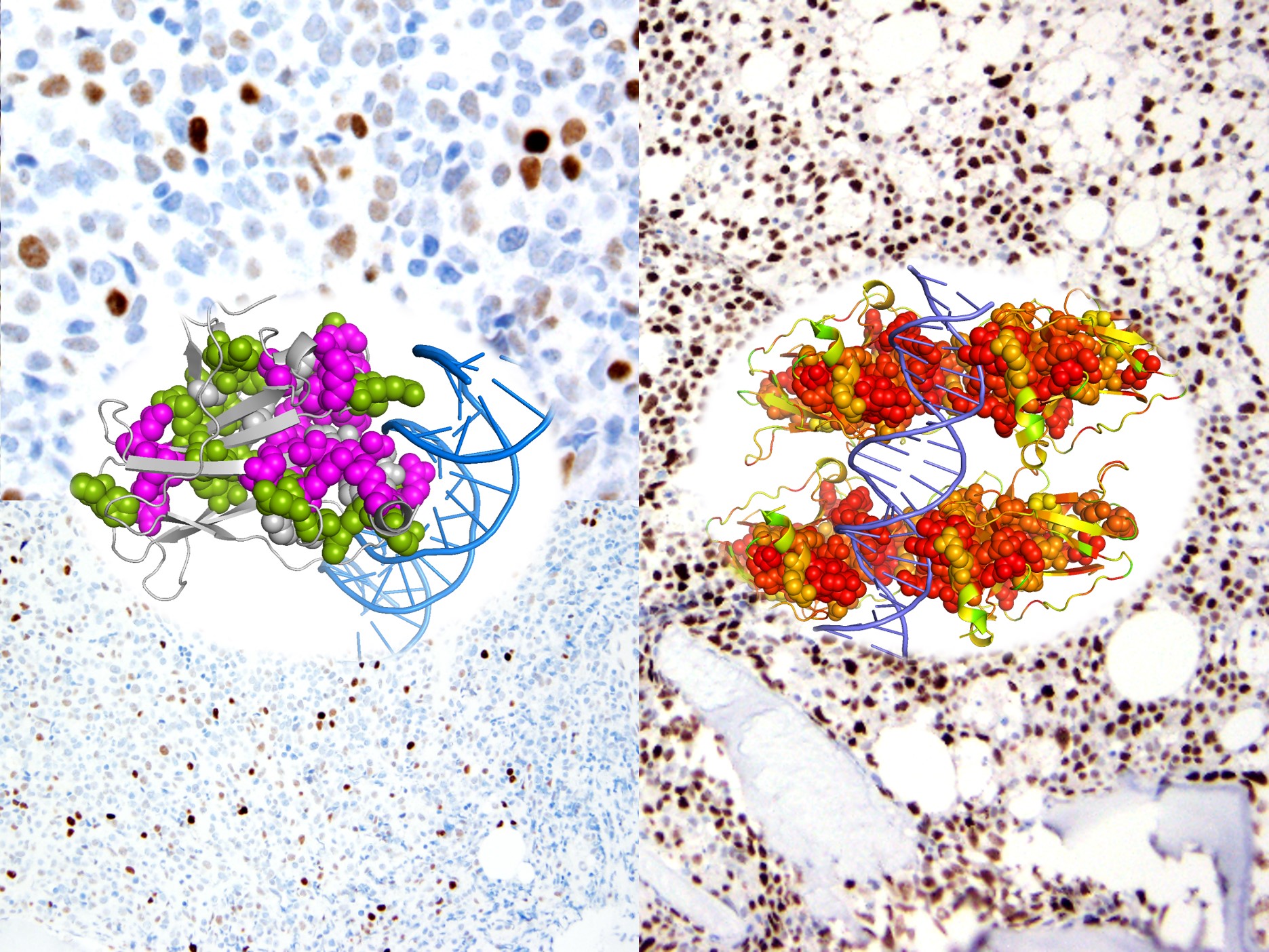 All TP53 mutations are NOT equal: 

Does the "deleterious effect" of the TP53 mutation affect the outcome of Myelodysplastic Syndrome? 

