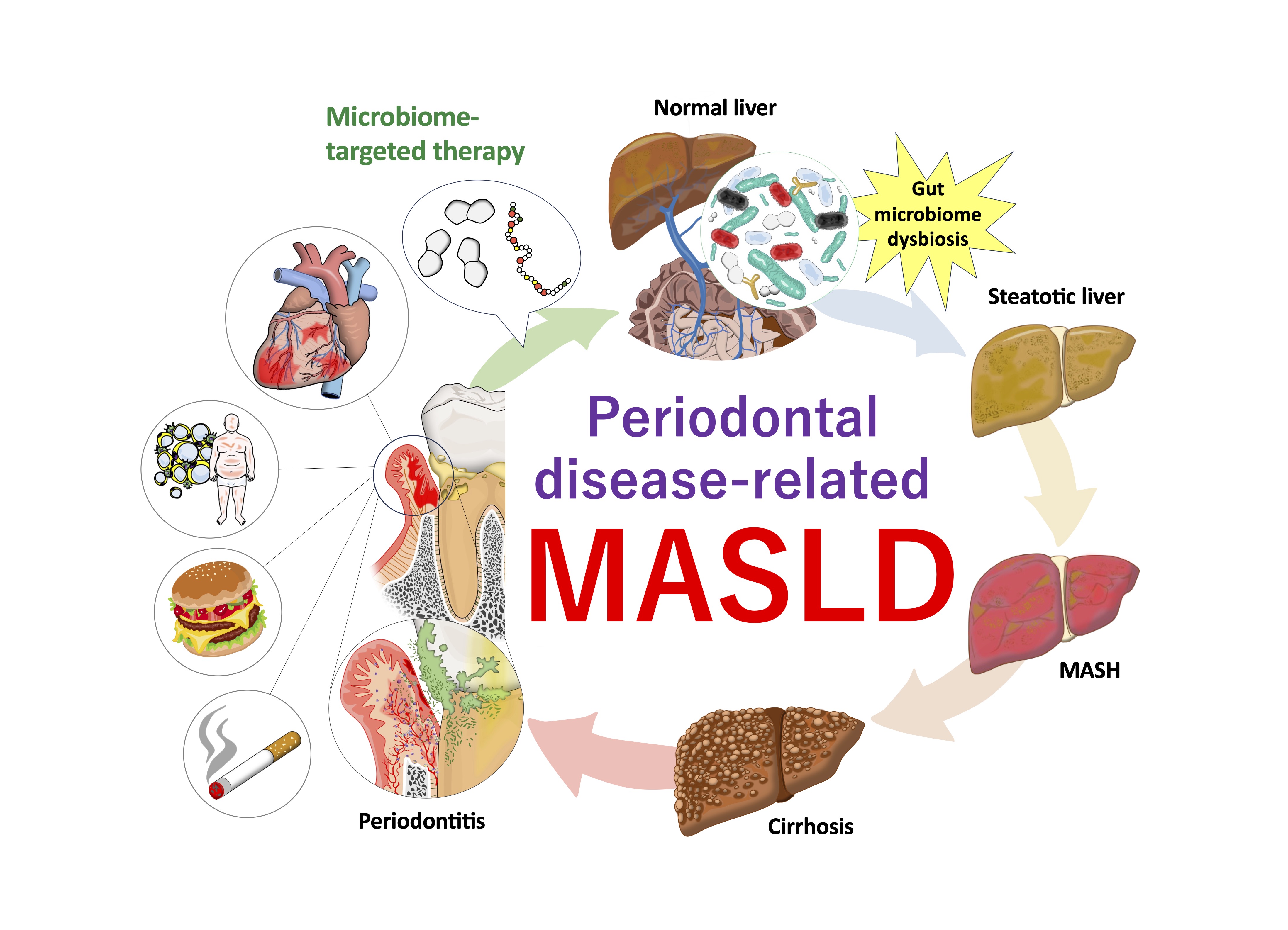 Potential disease definition of periodontal disease-related-MASLD/MASH and microbiome-targeted therapy via the oral-gut-liver axis 