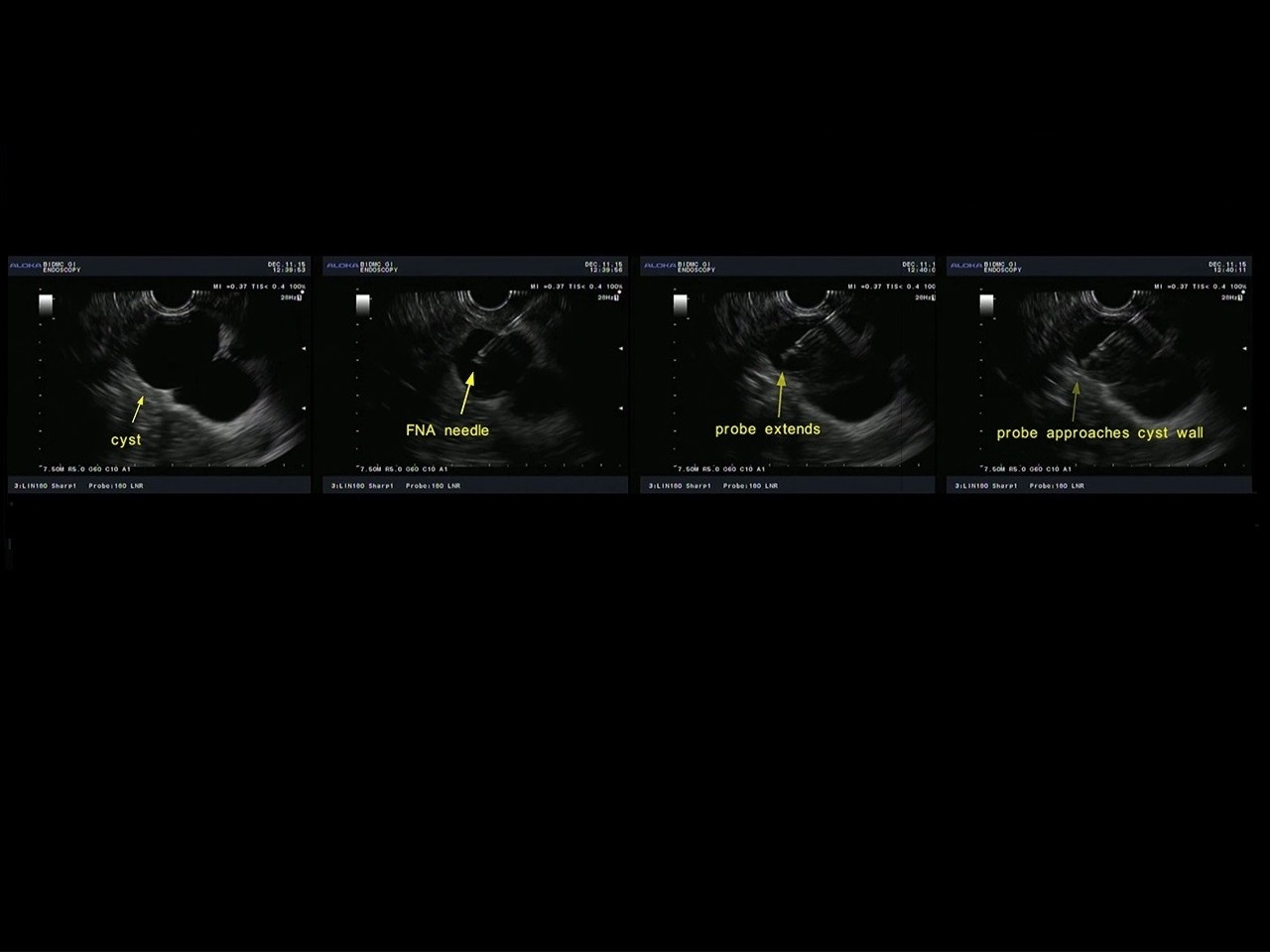 Light scattering spectroscopy identifies cysts with early pancreatic cancer