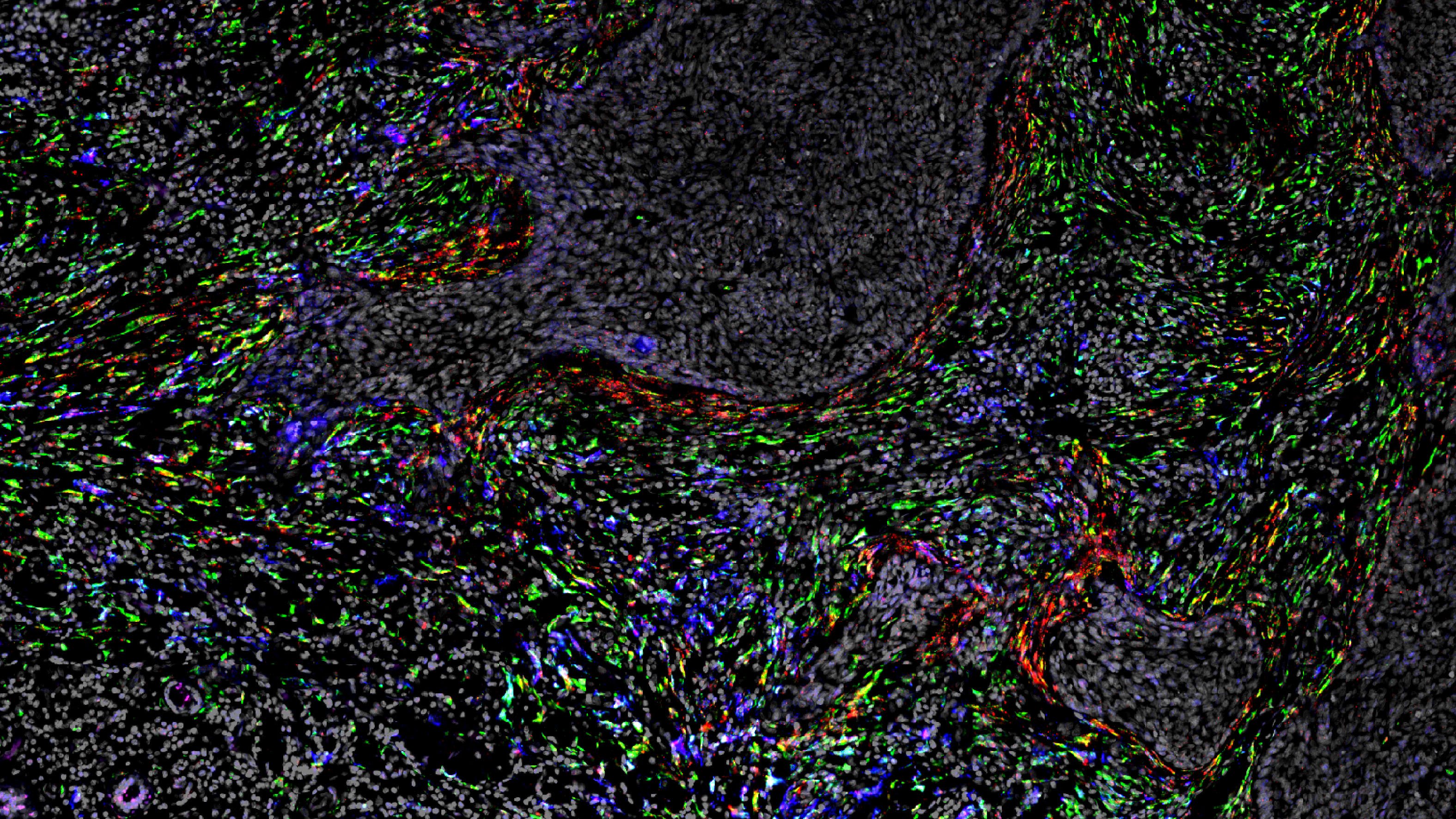 From Benign to Malignant: How iCAFs Shape the Skin Cancer Landscape