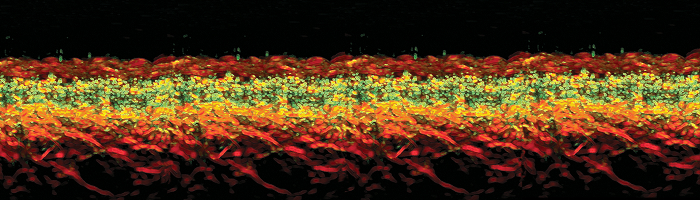 Ultra-broadband photoacoustic imaging of label-free psoriasis biomarkers