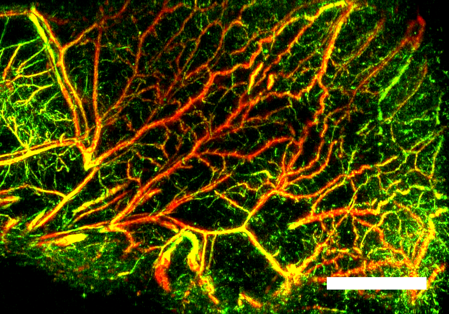 Optoacoustic imaging of tumour responses to vascular-targeted therapies
