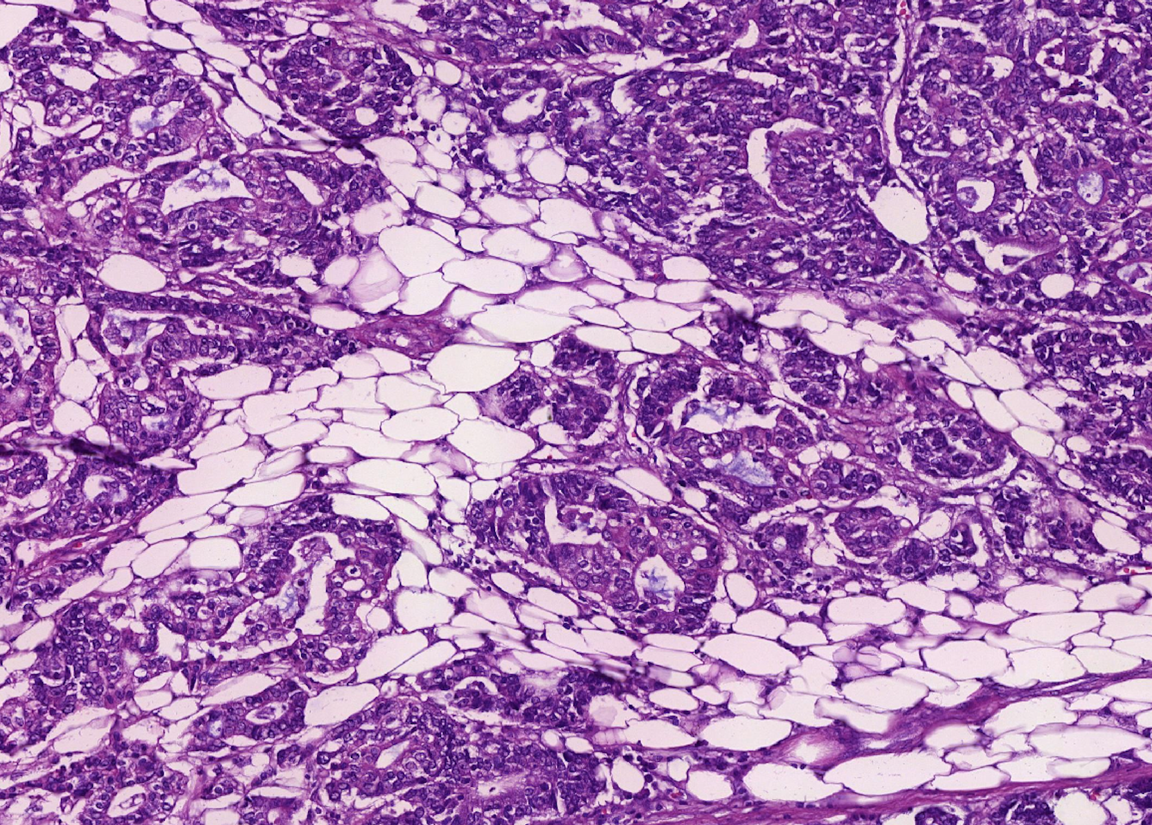 Why does direct tumor-adipocyte interaction matter in colorectal cancer pathology? 