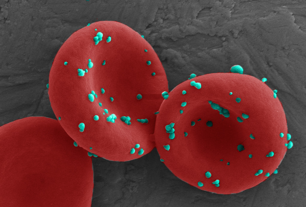 An erythrocyte mediated immunotherapy to leverage lung metastasis for cancer immunization