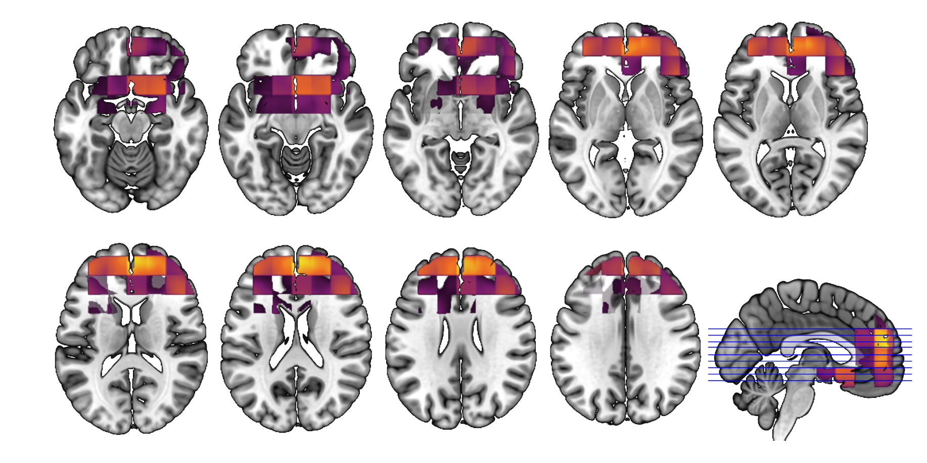 Looking beyond averages: Our study of lifestyle, depression, and brain ageing
