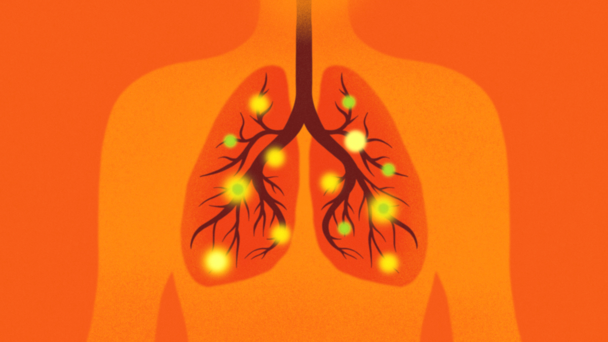 Call for papers: Lung Cancer