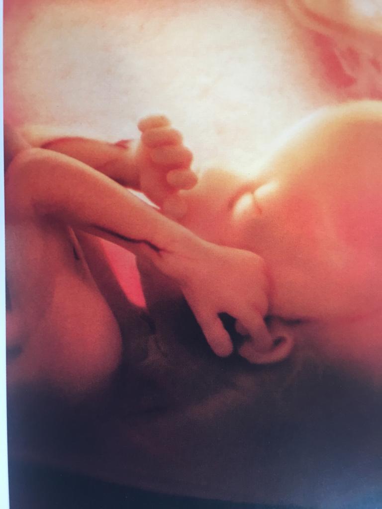 SARS-CoV-2 vertical transmission during pregnancy