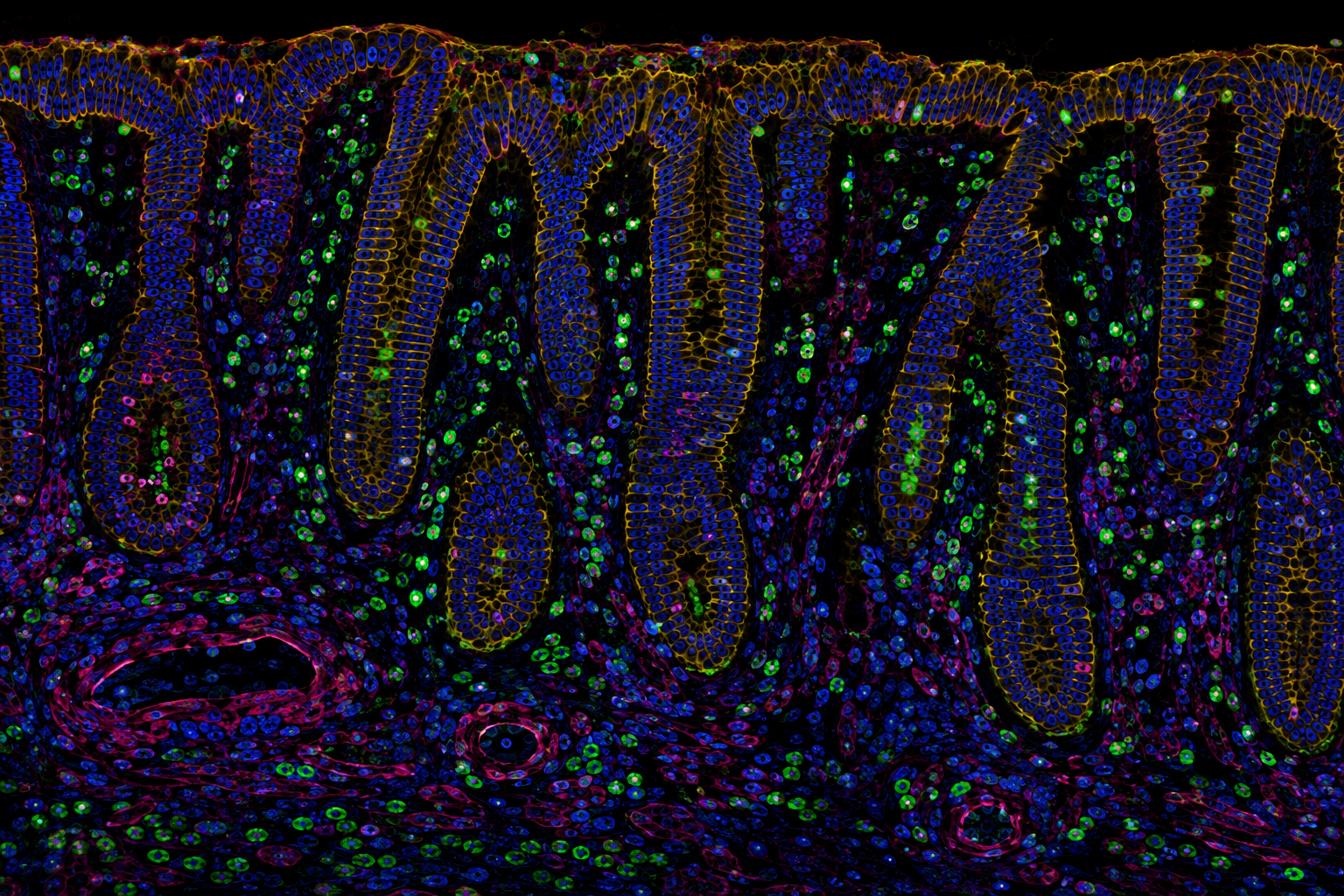 Intercepting colorectal cancer at the extremes of age
