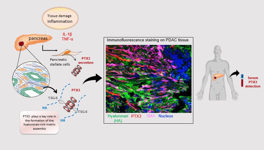 PTX3 protein as a detection biomarker in patients with pancreatic cancer.